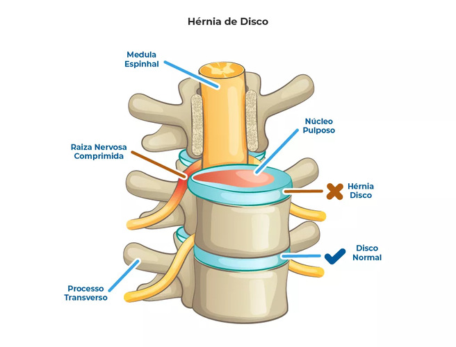 Lombalgia por hérnia de disco na coluna lombar