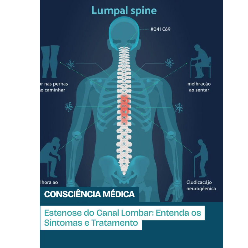 Estenose do canal lombar, dor nas pernas ao caminhar
